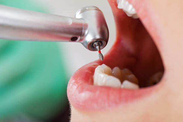Emergency Dental Filling Replacement in OR